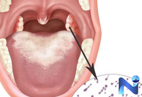 Bệnh bạch hầu có dễ nhận biết không?