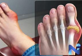 điều trị Bệnh gút (gout)