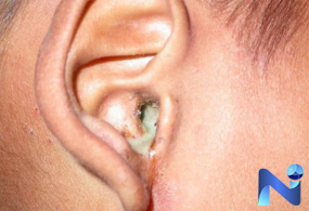 Điều trị nấm tai