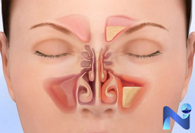 Điều trị xoang mãn tính