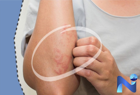 Tư vấm xét nghiệm dị ứng